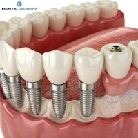 Image of Dentist Implants Bucks County