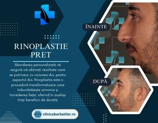 Rinoplastie Pret