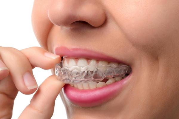 A close-up shot of a patient placing their invisalign braces wit