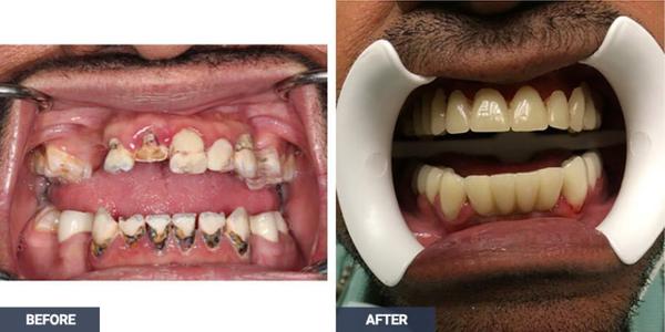 Image of Cavity Filling