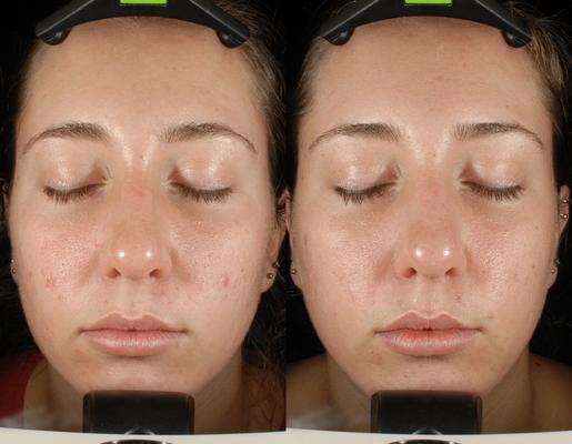 Image of SKIN IS IN : Acne & Anti-ageing Facials