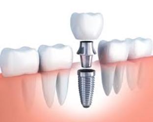 A cross section picture of a dental implant