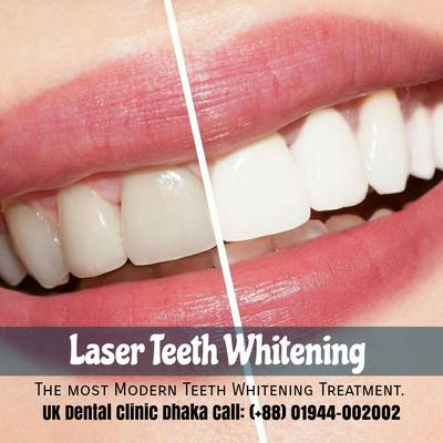 Laser Teeth Whitening ukdentalclinic dhaka bangladesh