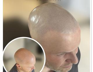 Image of Micro Scalp Marilyn | Micropigmentation Capillaire