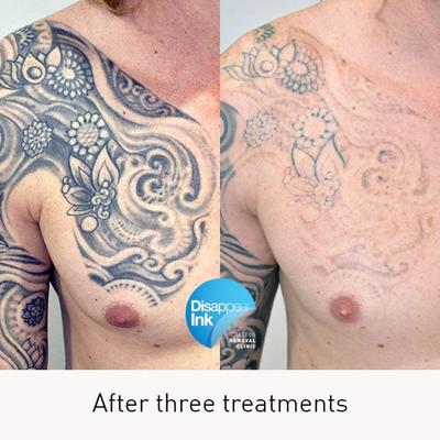 Image of Disappear Laser Clinic + Tattoo Removal