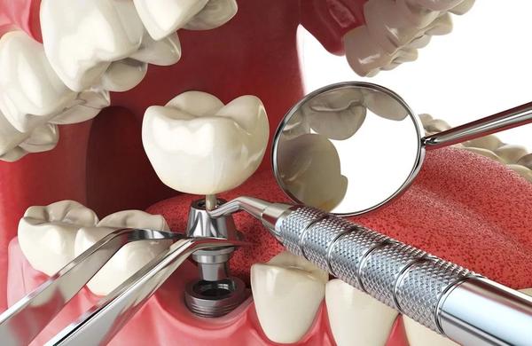Image of Wisdom Teeth Professionals