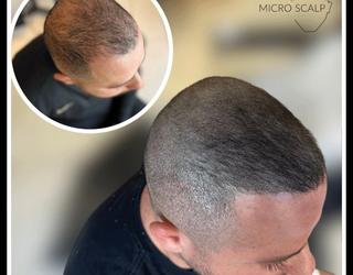 Image of Micro Scalp Marilyn | Micropigmentation Capillaire