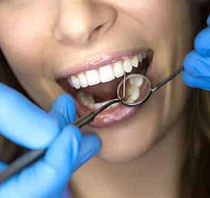 Image of Cavity Filling