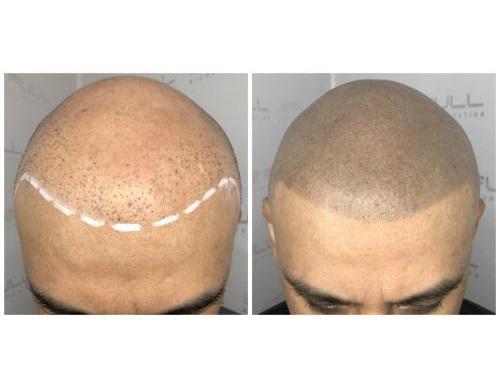 Full Micropigmentation