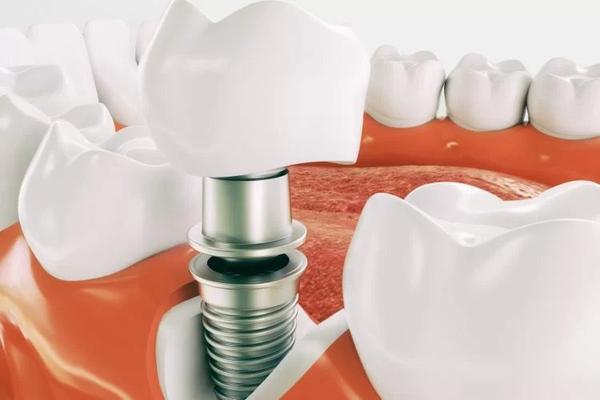 Image of Wisdom Teeth Professionals