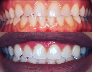 Teeth whitening in Humble, TX