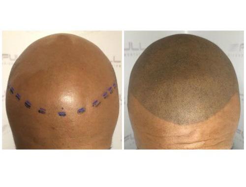 Full Micropigmentation