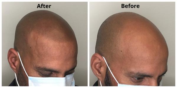 Image de Chroma Clinic Scalp Micropigmentation