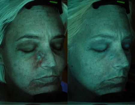 Image of SKIN IS IN : Acne & Anti-ageing Facials