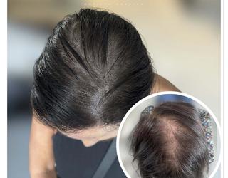 Image of Micro Scalp Marilyn | Micropigmentation Capillaire