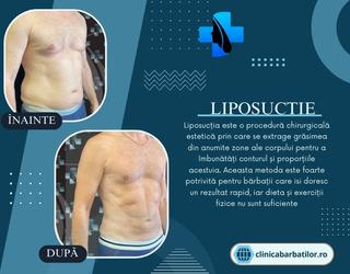Liposuctie