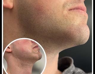 Image of Micro Scalp Marilyn | Micropigmentation Capillaire