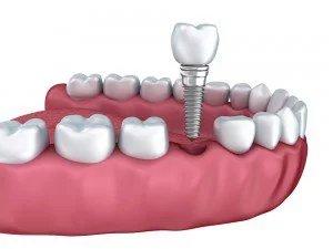 Image of Wisdom Teeth Professionals